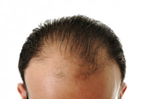 Balding_Head