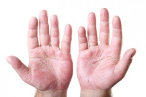 Eczema_On_Hands