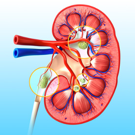 Kidney_Stones_In_Kidney