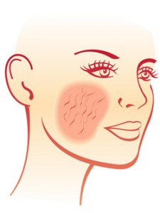 New Clues About Rosacea and Eczema